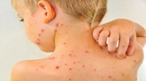 Các bệnh về da thường gặp trong mùa hè