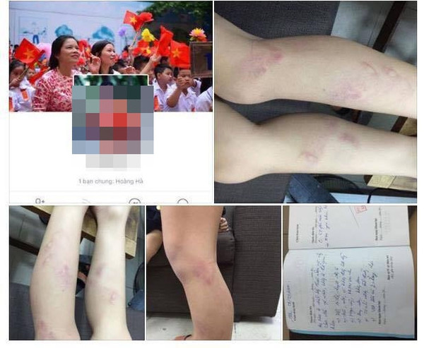 Cô giáo đánh tím chân học sinh: Chủ tịch Hà Nội yêu cầu làm rõ