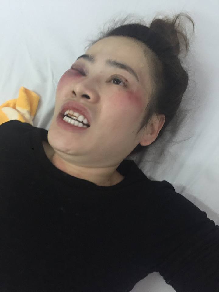 Đà Nẵng: Giành ăn bánh xèo, nam thanh niên đánh cô gái trẻ nhập viện