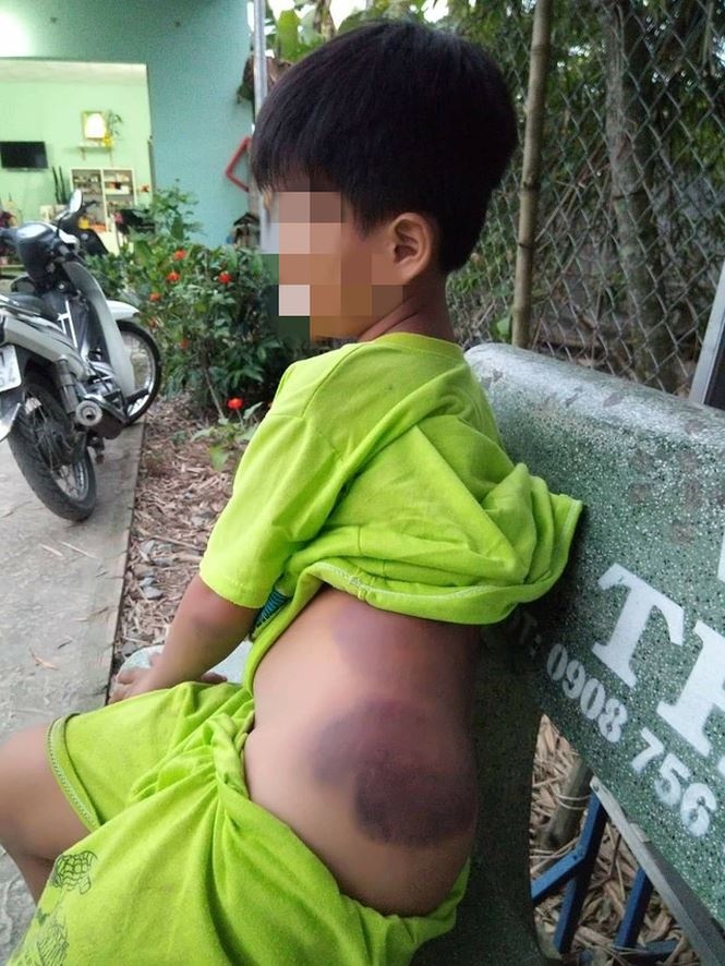 NÓNG: Bé trai tiểu học khuyết tật bị cô giáo đánh bầm tím người