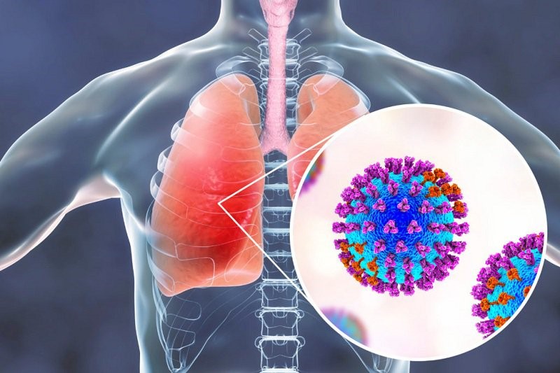 COVID-19 có thể gây tổn thương phổi kéo dài - Ảnh 2.