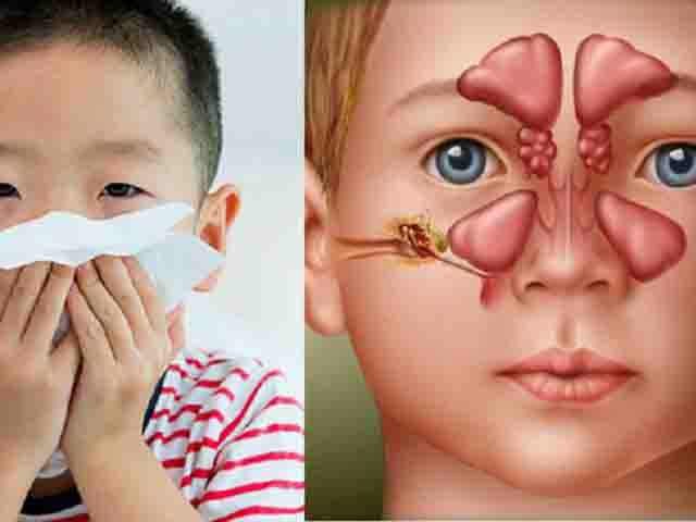 Cảnh giác với viêm mũi xoang cấp do vi khuẩn ở trẻ - Ảnh 2.