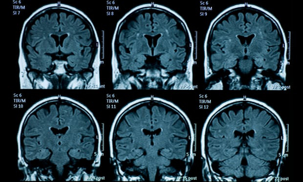 Não bộ người có dấu hiệu lão hóa nhanh hơn sau đại dịch - Ảnh 1.