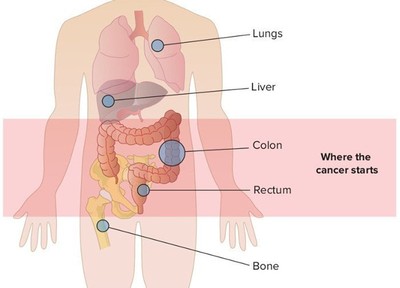 Ung thư di căn có nghĩa là gì?