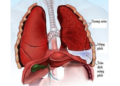 Tràn dịch màng phổi: Mối đe dọa khó lường