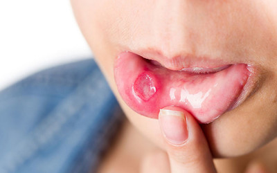 Nhiệt miệng là gì? Nguyên nhân và cách phòng ngừa