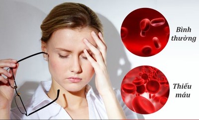 Dấu hiệu và cách điều trị bệnh thiếu máu