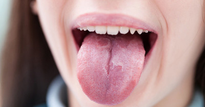 Lưỡi có những biểu hiện lạ này chứng tỏ cơ thể đang có bệnh
