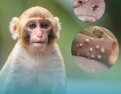 Bộ Y tế ban hành hướng dẫn chẩn đoán, điều trị và phòng bệnh đậu mùa khỉ