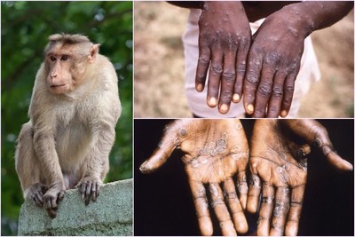 Sử dụng vaccine phòng bệnh đậu mùa khỉ cho những nhóm đối tượng nào?
