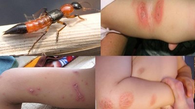 Những sai lầm thường gặp trong điều trị tổn thương do kiến ba khoang