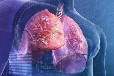 Cần Thơ: Tăng cường giám sát viêm phổi nặng do virus