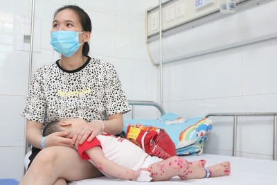 Hà Nội: Số trẻ mắc tay chân miệng tăng trên 100% so với cùng kỳ năm ngoái