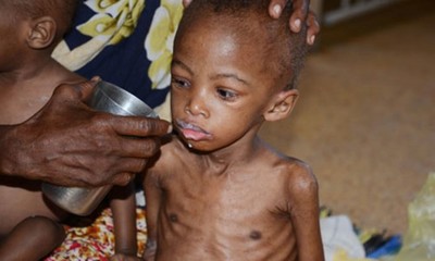Cảnh báo về tình trạng suy dinh dưỡng ở trẻ em tại vùng Sừng châu Phi