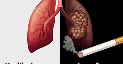 Gần 97% bệnh nhân ung thư phổi có hút thuốc lá
