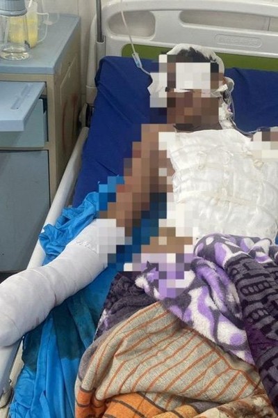 Đắk Nông: Một nam sinh bị thương nặng do tự chế pháo nổ