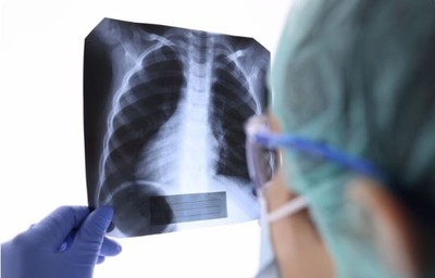 Chụp X quang phổi trắng cảnh báo bệnh gì?
