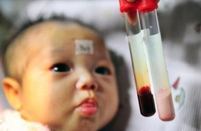 Mỗi năm Việt Nam có thêm khoảng 8.000 trẻ mắc bệnh Thalassemia
