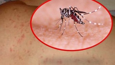 7 quan niệm sai lầm về sốt xuất huyết khiến bệnh dễ trở nặng