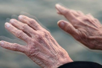 Khuyến nghị mở rộng xét nghiệm di truyền để phát hiện sớm bệnh Parkinson